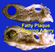 Clog Artery